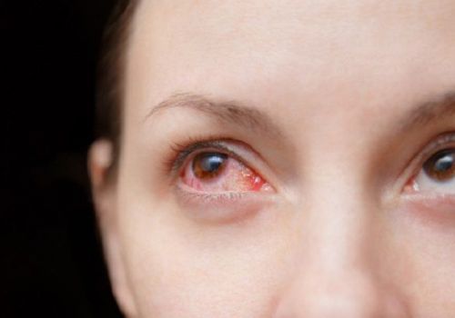 Đau mắt đỏ có thể là triệu chứng của COVID-19?